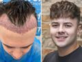 Résultats d’un implant de cheveux : à quoi s’attendre et quand ?