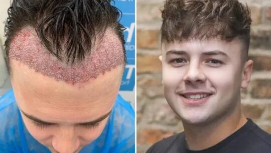 Résultats d’un implant de cheveux : à quoi s’attendre et quand ?