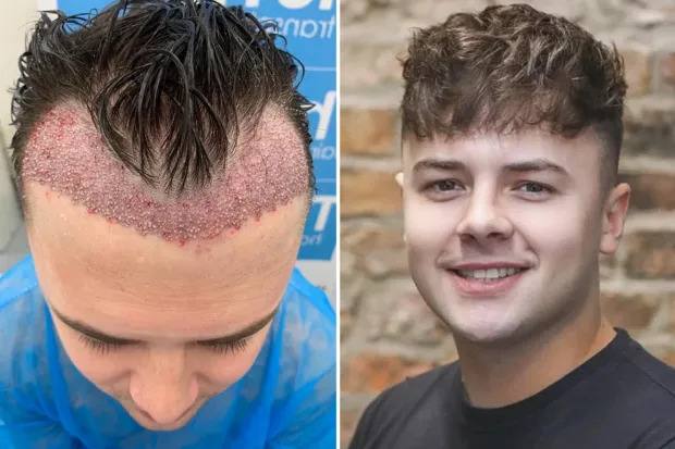 Résultats d’un implant de cheveux : à quoi s’attendre et quand ?