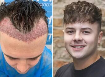 Résultats d’un implant de cheveux : à quoi s’attendre et quand ?